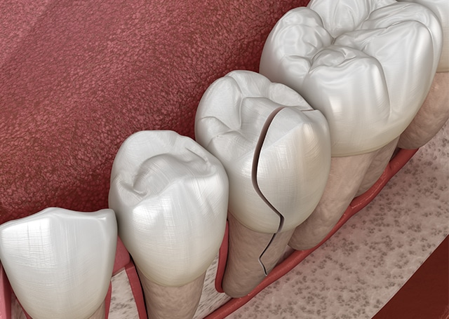 Dental Emergencies McDonald PA